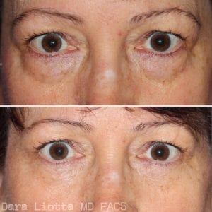 Lower Eyelid Surgery Dr Dara Liotta