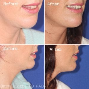 Chin and Submental Liposuction 03 - Dr. Dara Liotta