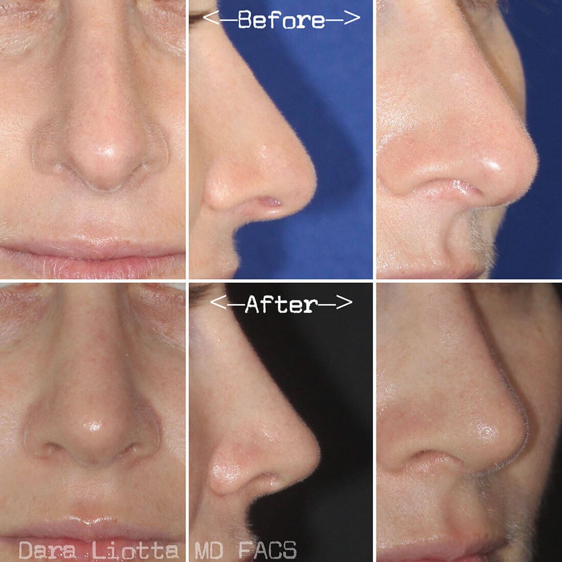 Rhinoplasty Archives Page Of Dr Dara Liotta